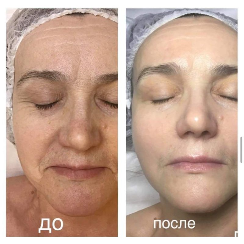 Serum Retinol 4% Dưỡng Da Chuyên Sâu Onmacabim Neutrazen R 15 ml