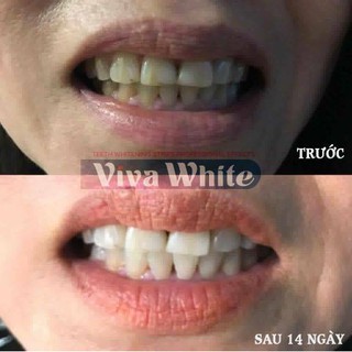 Miếng Dán Làm Trắng Răng Viva White
