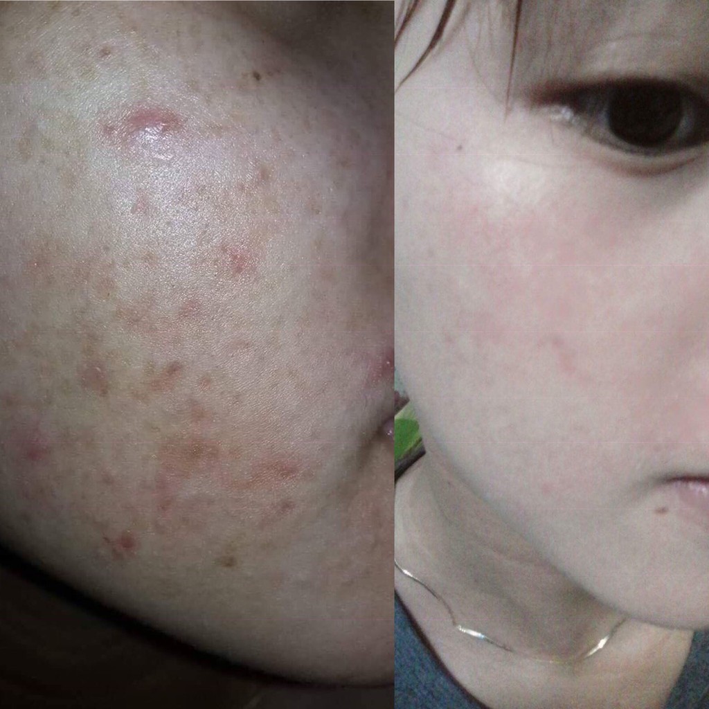 Cao lá nam trị mụn 💜 Chuyên sỉ SLL Cao lá nam trị mụn handmade | BigBuy360 - bigbuy360.vn