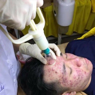 Bộ giác hơi hút mun viêm, máu độc...(1 súng và 10 ống)