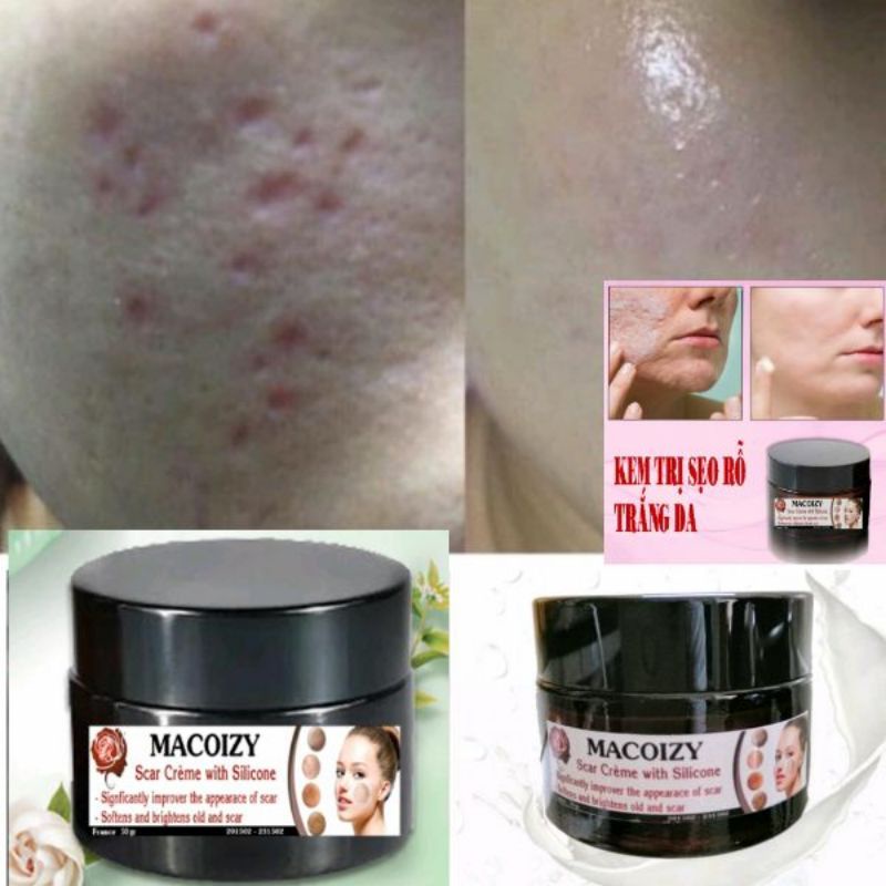 Kem Xóa Sẹo Rỗ Sẹo Mụn Sẹo Thâm