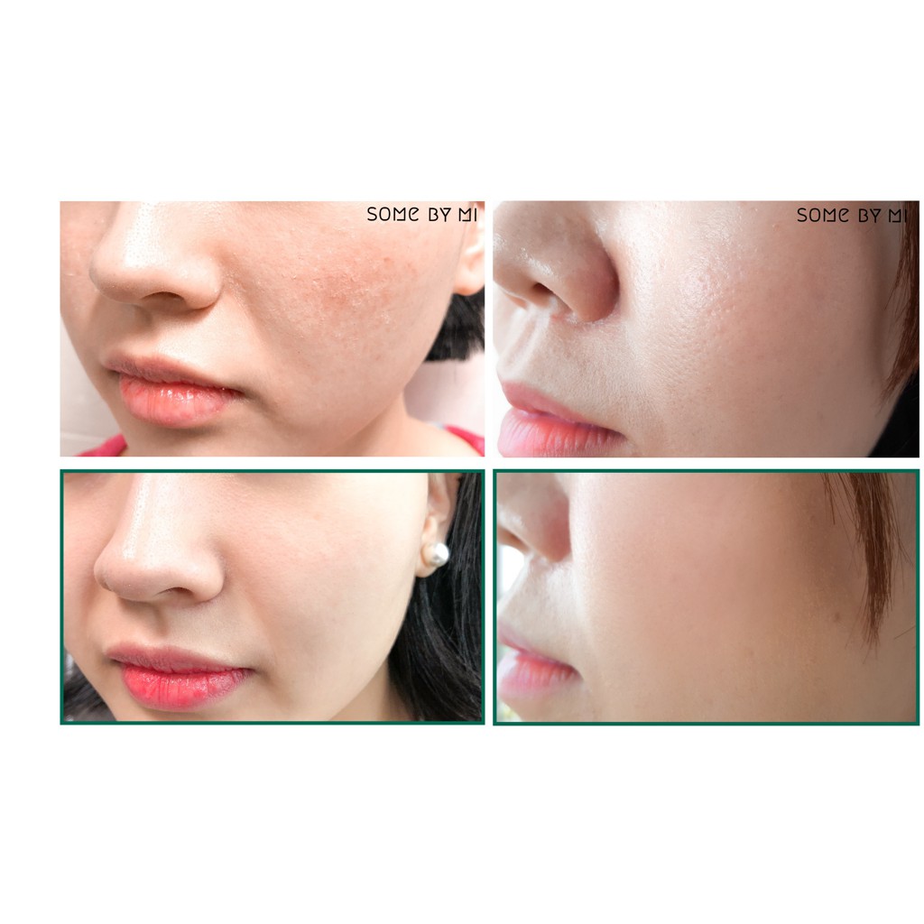 Sữa rửa mặt Some By Mi AHA-BHA-PHA 30 days Miracle Acne Clear Foam | BigBuy360 - bigbuy360.vn