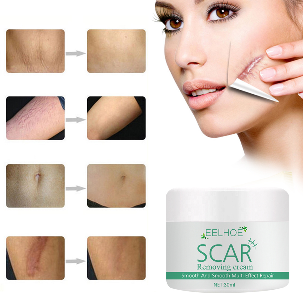 (Hàng Mới Về) Kem Trị Sẹo Và Vết Rạn Da 30ml Cao Cấp