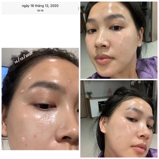 Serum tẩy da chết The Ordinary AHA 30% + BHA 2% Peeling Solution 30ml