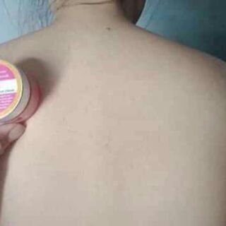 Mụn lưng, viêm lỗ chân lông