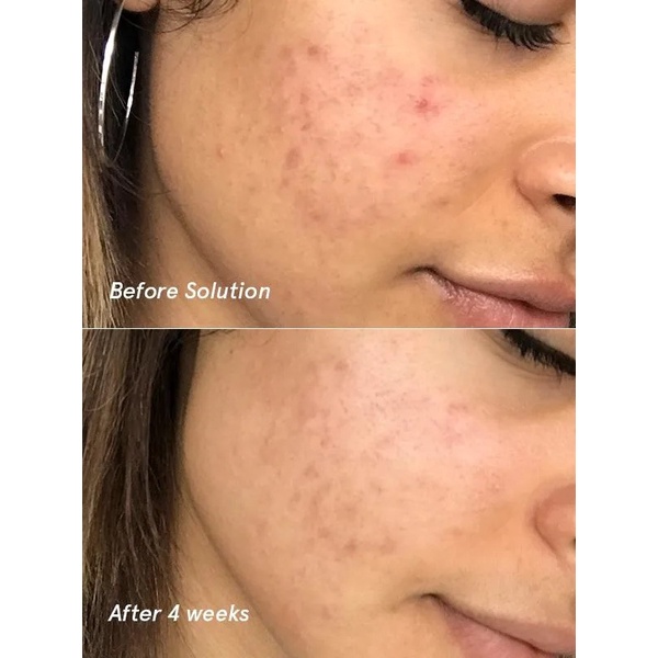 GLOSSIER Solution Toner - Toner tẩy tế bào chết hóa học AHA/BHA/PHA