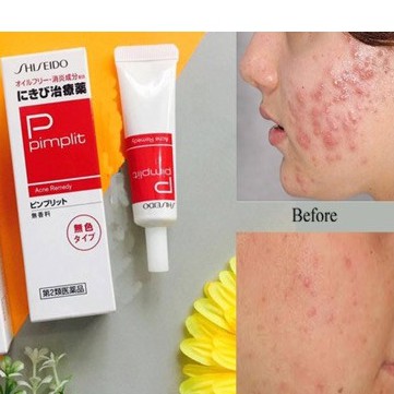 Kem mụn Pimplit shiseido nhật bản giúp giảm sạch mụn