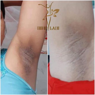BIHO LADI [COMBO 2 HỘP] SIÊU DƯỠNG THÂM 5S (LOẠI BỎ THÂM KHỬ MÙI NÁCH MÔNG BẸN BIKINI NHŨ HOA)
