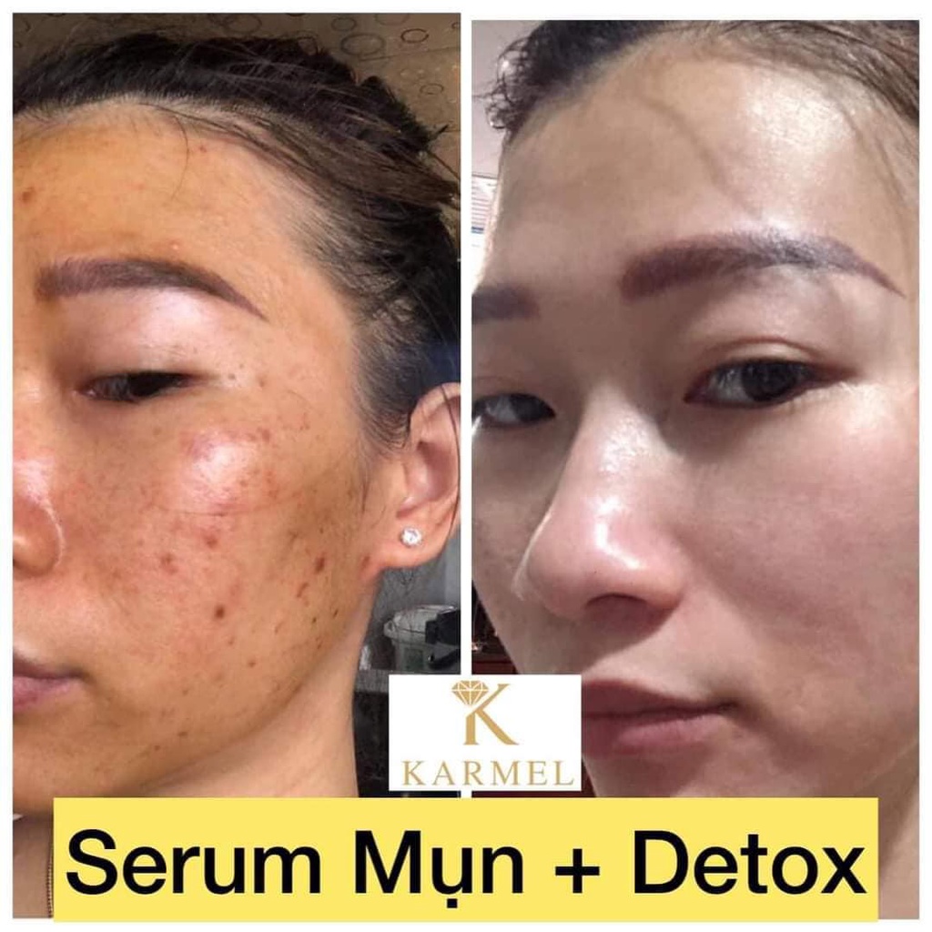 Serum Loại Bỏ Mụn đầu đen, bã nhờn, da sần vỏ cam, mờ vết thâm nám, tái tạo da, dưỡng trắng da-Detox Acnes Karmel(Kamel)