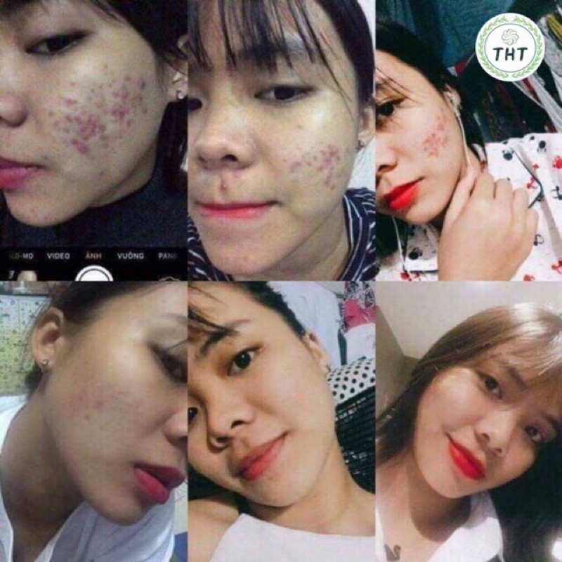 SERUM GIÚP TÁI TẠO DA hết mụn, thâm hiệu quả handmade | BigBuy360 - bigbuy360.vn