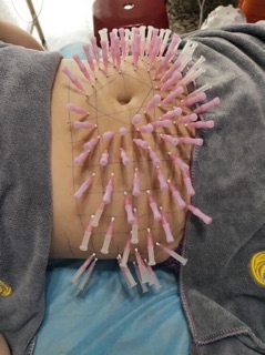 chỉ xoắn tiêu mỡ