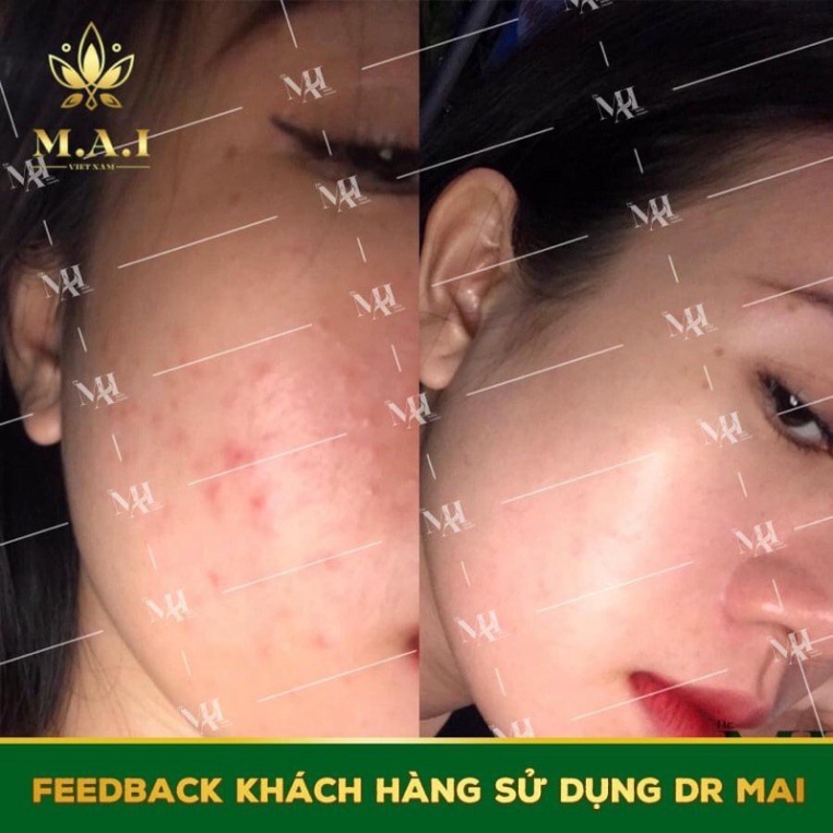 ✅  Dr Mai  serum Mai Thảo Mộc, lựa chọn hoàn hảo cho làn da mụn