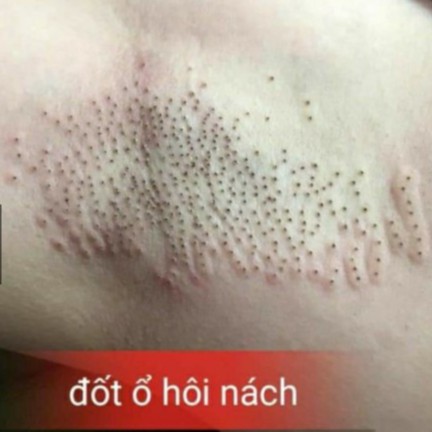 Đốt ổ Hôi Nách Dành Cho Spa (1 gói)