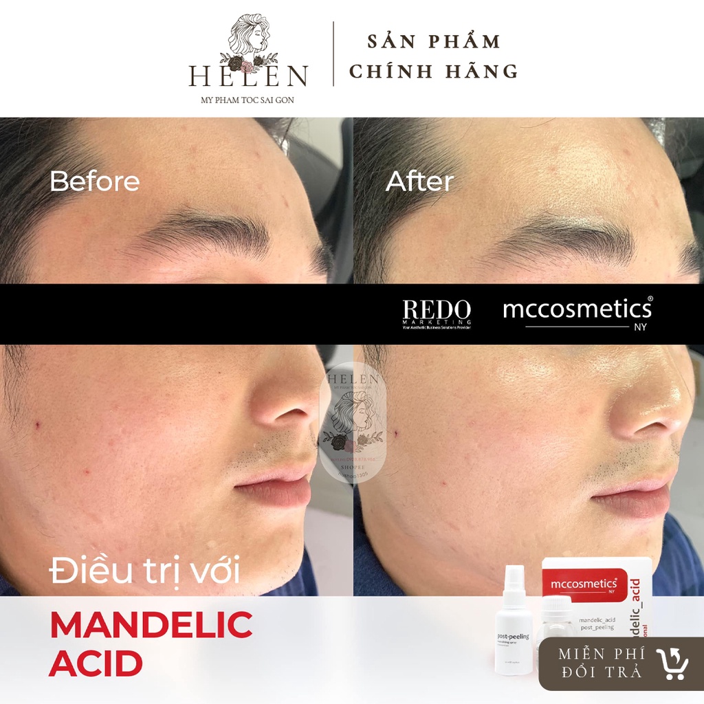 Peel MANDELIC MCCM & MCCOSMETIC-Tạm biệt nám, tàn nhang cho làn da nhạy cảm