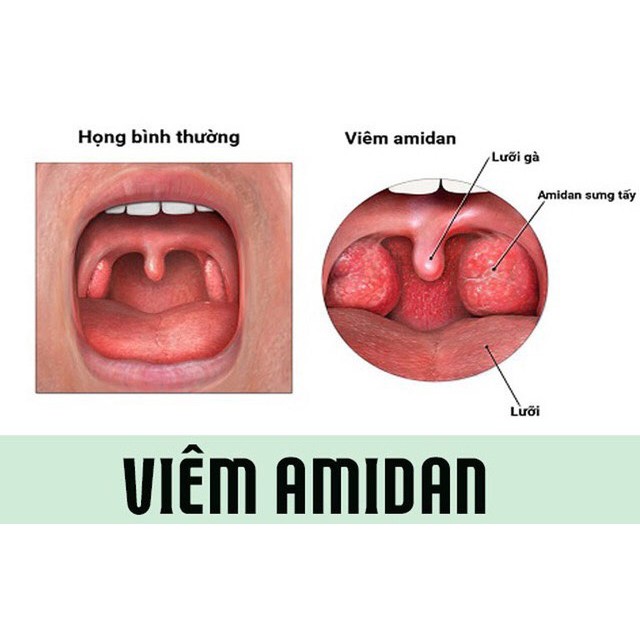 [100% THIÊN NHIÊN] Tinh Dầu Răng Miệng - Dạ Thảo Liên Hỗ Trợ Trị Hôi Miệng, Sâu Răng, Viêm Lợi