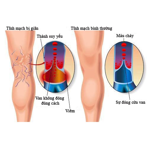 Tất giãn tĩnh mạch gối - sản xuất tại Hoa Kỳ