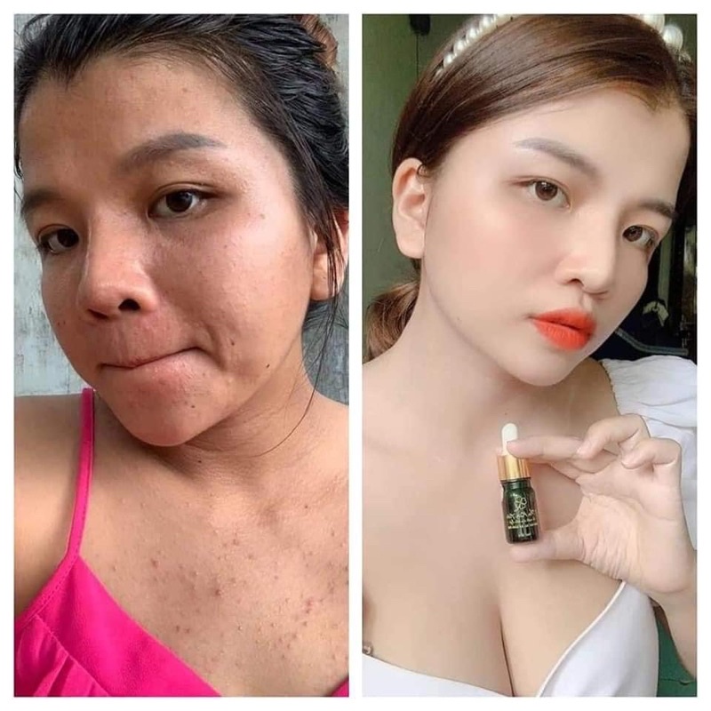 An Kim Tiền_Serum mụn_thể tích 5ml_dung dịch màu đen | BigBuy360 - bigbuy360.vn