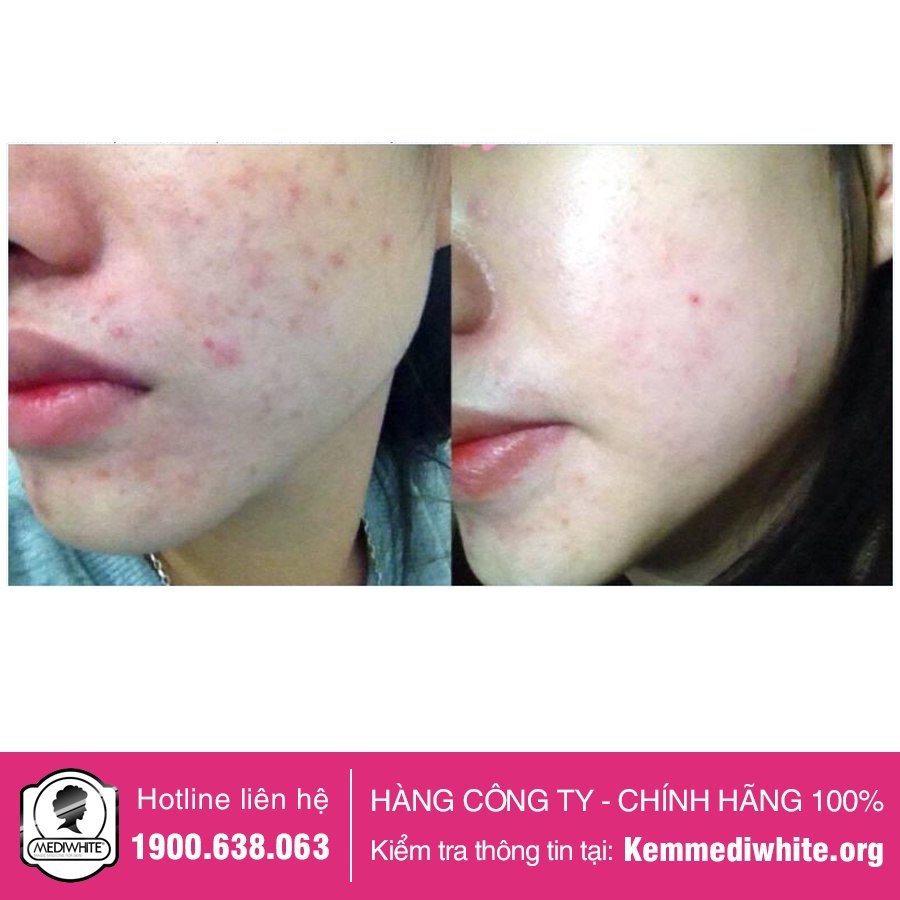 Kem Mụn Medi White Chính Hãng - Medi Acne - Kem Ngừa Mụn Sáng Da Mờ Thâm Medi White - Hàng Công Ty