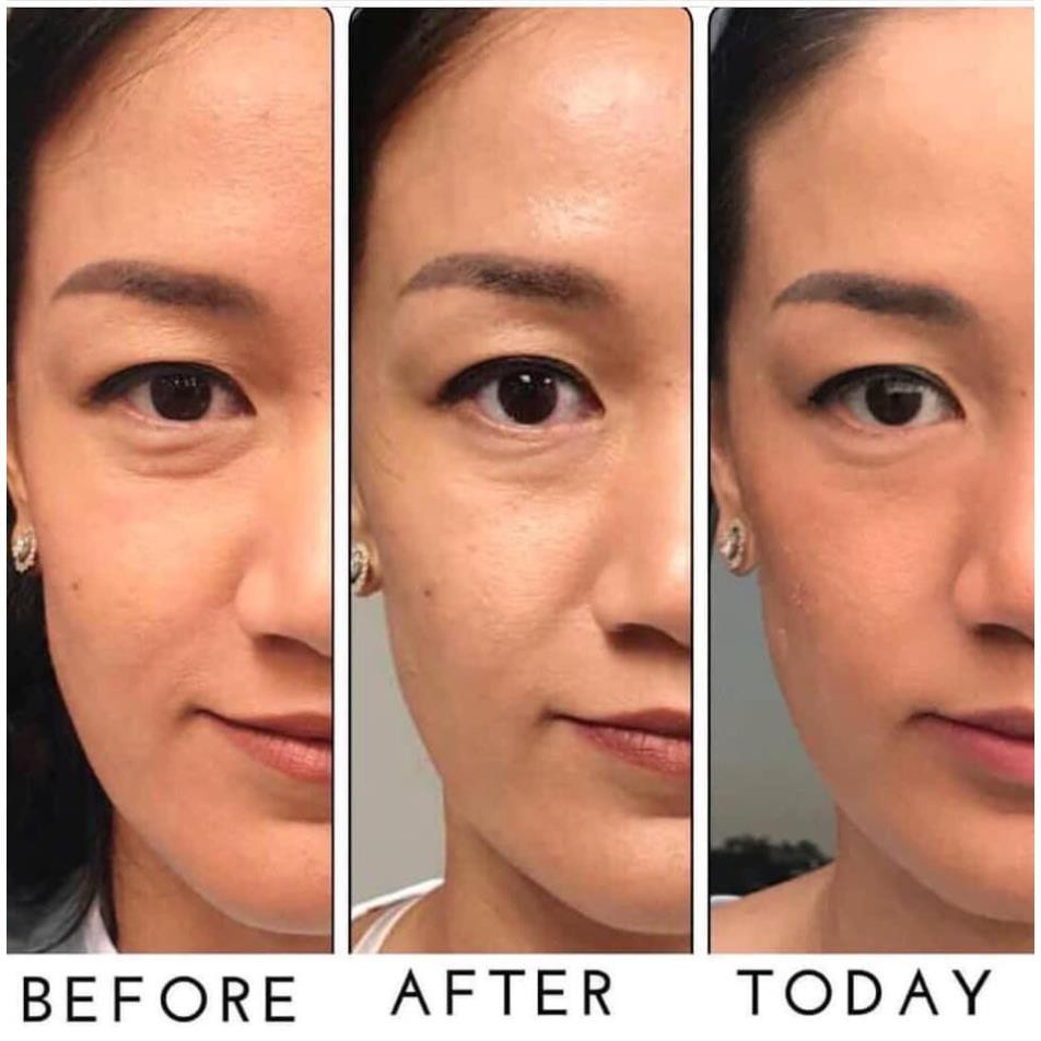 Đầu LumiSpa Accent Tip IdealEyes chăm sóc vùng mắt chống nhăn quầng thâm mắt chống lão hóa cho mắt