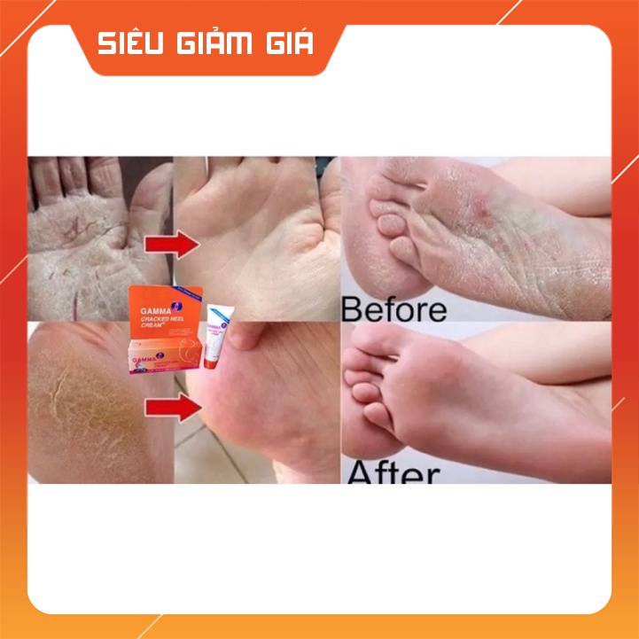 Kem giảm nứt gót chân, khô nứt da Gamma Cracked Heel sản phẩm chuyên dùng cho da khô nứt nẻ cho kết quả cực kỳ tốt. ...