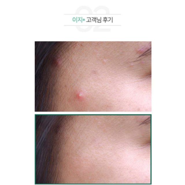 Tinh Chất "Thần Kỳ" Some By Mi AHA-BHA-PHA 30 Days Miracle Serum 🌿
[Trị Sạch Mụn Chỉ Trong 30 Ngày]