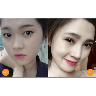 MIẾNG DÁN KÍCH 2 MÍ SURI MIRA