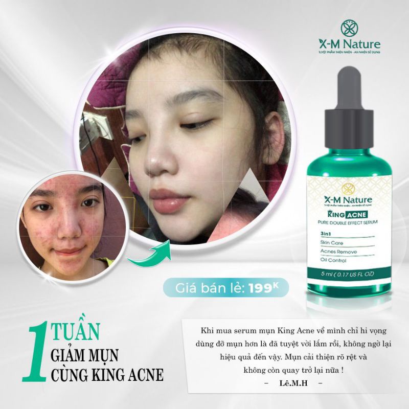 Combo 5 SRUM MỤN KING ACNE Xm-Nature