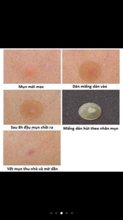 Miếng dán mụn mayan care -20 miếng