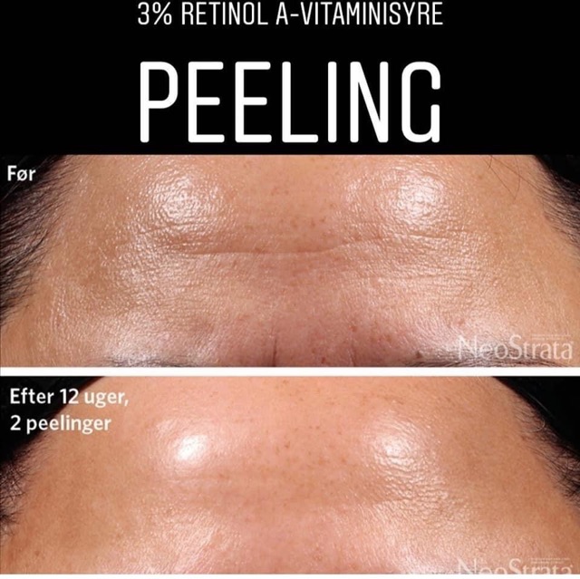 Thay da sinh học NeoStrata ProSystem Retinol Peel