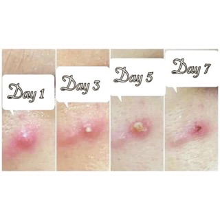 Miếng dán mụn 42+42 miếng khuyến mãi