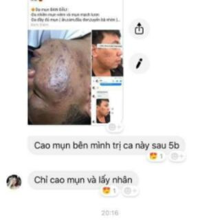 Cao mụn cure medicine