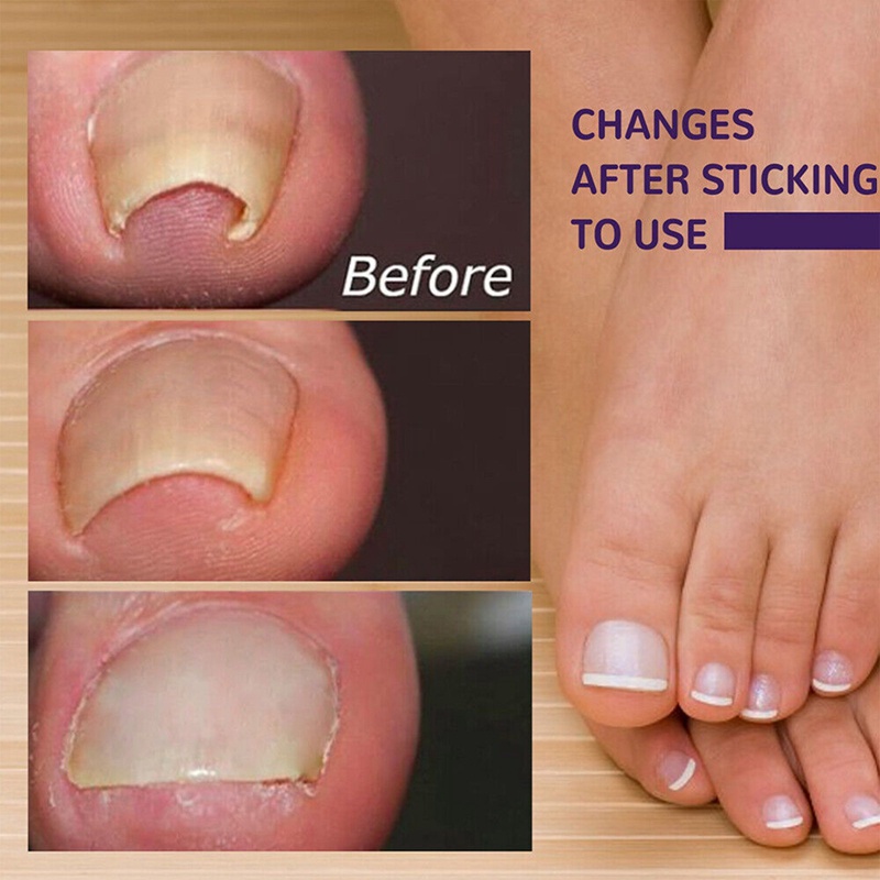Set 50 Miếng Dán Điều Chỉnh Móng Chân Mọc Ngược