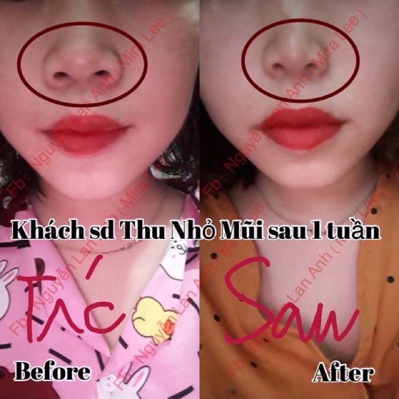 Tinh chất Miracle Pháp thu nhỏ cánh mũi, hiệu quả chỉ sau 14 ngày