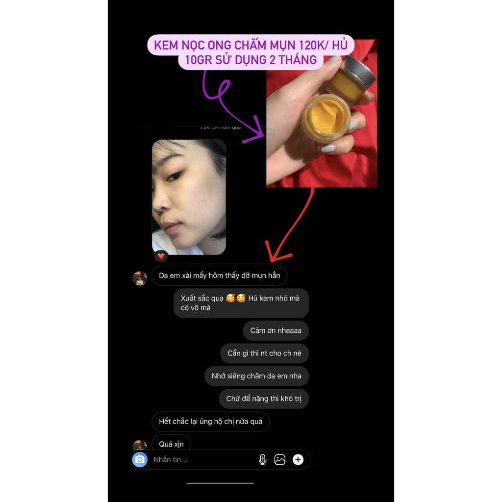 KEM NỌC ONG CHĂM SÓC DA MỤN - THÂM SAU MỤN | BigBuy360 - bigbuy360.vn