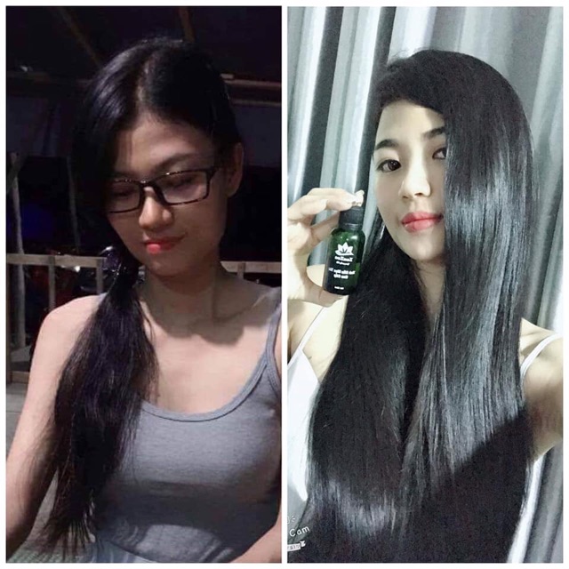 Tinh dầu mọc tóc ZonZon