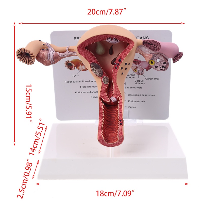 Mô Hình Lối Đi Bệnh tật Bằng Tiếng Ồn Người Phụ Nữ Uterus