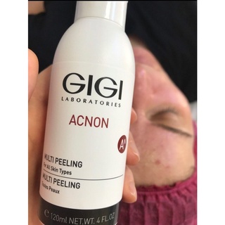 Gel xử lý mụn gigi acnon multi peeling