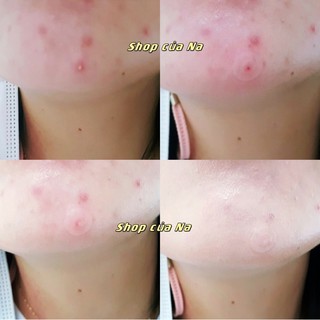 Miếng dán mụn Careplus của Olive Young