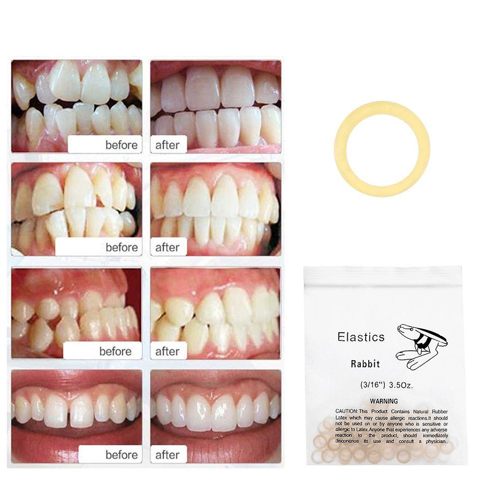 Nhẫn Chỉnh Hình Răng Chăm Sóc Sức Khỏe