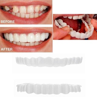 Nẹp răng Snapon Smile