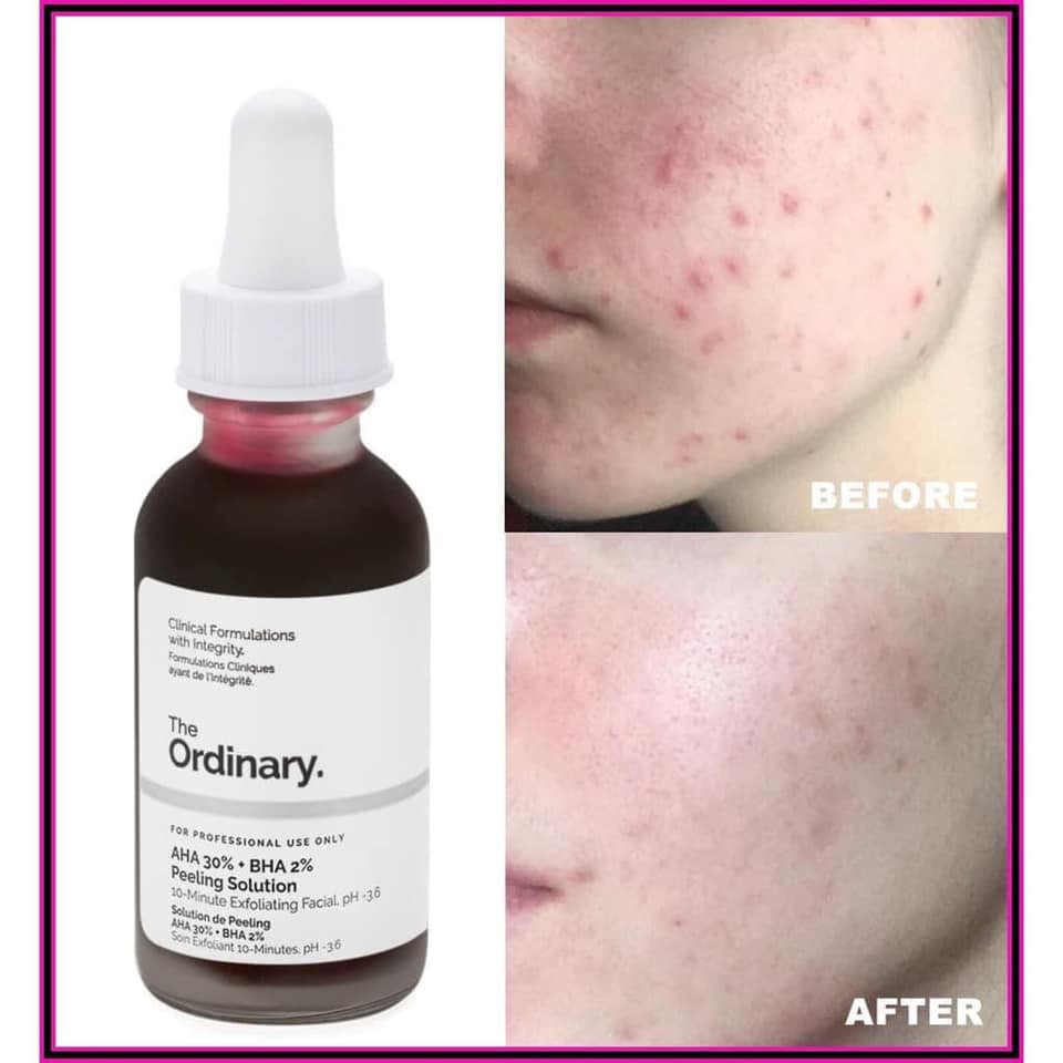 Tinh chất tẩy tế bào chết AHA 30% + BHA 2% Peeling Solution - The Ordinary | WebRaoVat - webraovat.net.vn