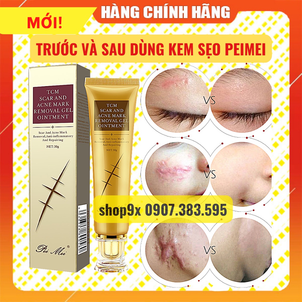 Kem Sẹo Peimei - Giảm Sẹo Và Rạn Da Hiệu Quả Sau 1 Tuần 30gr