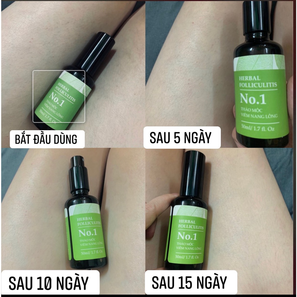 Xịt Viêm Nang Lông - Hoa Hồng Cosmetic- VNL