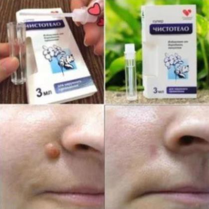 Gel Tẩy Nốt Ruồi, Mụn Cóc, Mụn Thịt, Tàn Nhang, Sẹo Lồi Dvelinil - Chính Hãng Nga