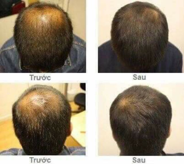 Xịt mọc tóc MAHAAD Thái Lan