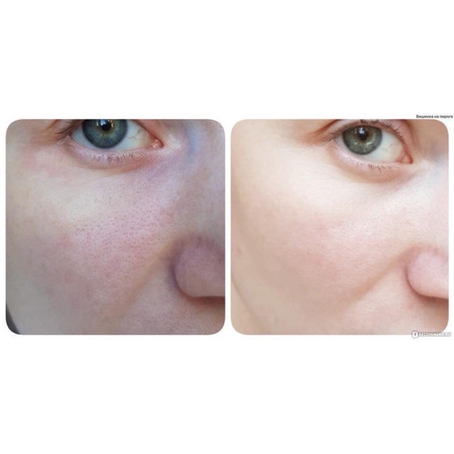 Liệu trình thay da 10 ngày serum Teana Fungusto