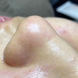 Ủ MỤN REMOVES BLACKHEADS