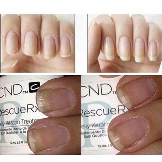 Phục hồi móng hư tổn CND