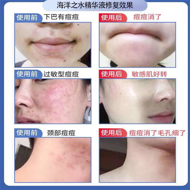Tinh Chất Dưỡng Ẩm Chăm Sóc Lỗ Chân Lông Chăm Sóc Cơ Thể Se Khít Lỗ Chân Lông Khối Lượng Lớn meticulou Chăm Sóc Chăm Sóc Sự Thẩm Thấu Sâu | BigBuy360 - bigbuy360.vn