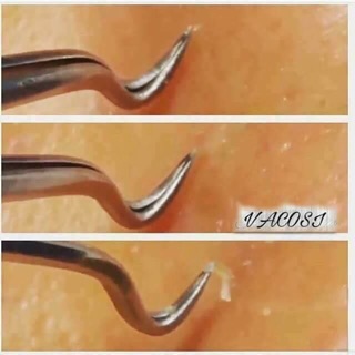 Nhíp gắp mụn Thần thánh Vacosi